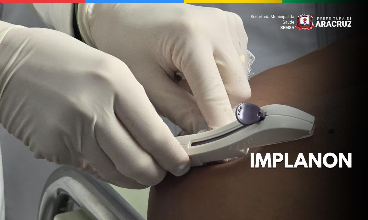 Implanon passa a contar com protocolo específico na Atenção Primária à Saúde